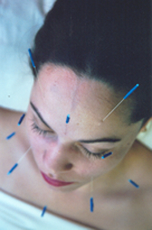 Acupuncture facelift example picture