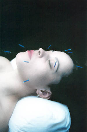 Acupuncture facelift example picture